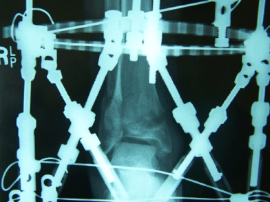 X-ray Result of Complex Ankle Pilon Fracture During Surgery