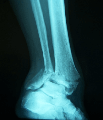 X-ray Result of Complex Ankle Pilon Fracture Before