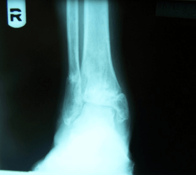 X-ray Result of Complex Ankle Pilon Fracture After